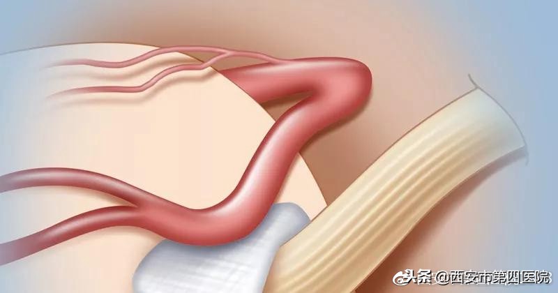 什么叫面肌痉挛,非典型面肌痉挛如何治疗