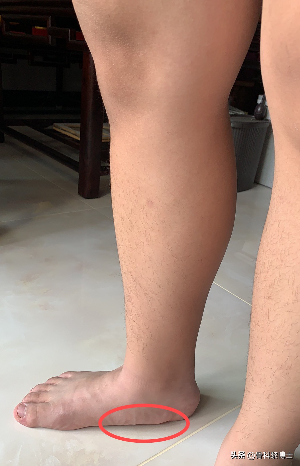 学生训练小腿疼痛是什么原因,中考体育1000米小腿痛