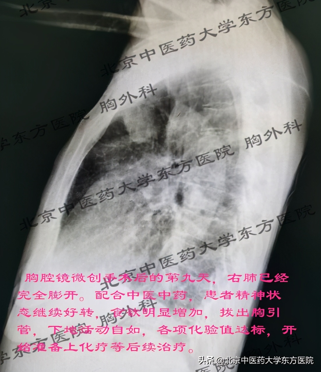 北京治疗胸腔积液哪个医院权威,中医治疗心脏胸腔积液