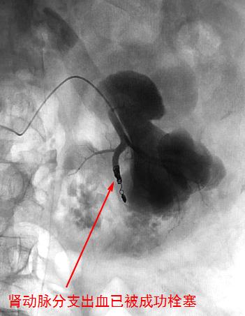 尿血便血同时出现怎么办,便血尿血去看什么科