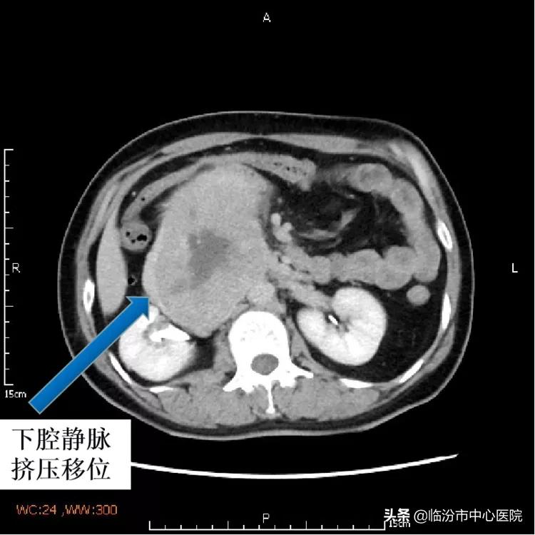 临汾市中心医院手术,临汾市中心医院腹腔镜手术