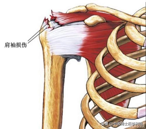 中医教授讲肩周炎,肩膀疼痛与肩周炎的区别