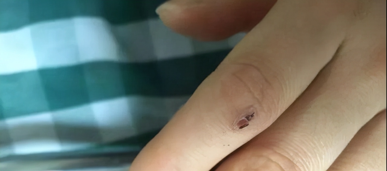 湖南七旬老人被毒蛇咬伤！抗蛇毒血清为什么这么少？