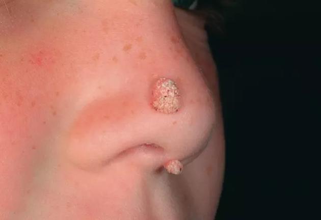 瘊子会自己消失不用治？NO！你的瘊子会传染全家人！