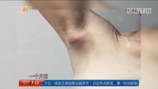 副乳里面有硬块要切除吗,副乳在腋窝下存在什么风险
