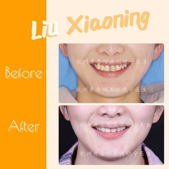 杭州舌侧牙齿矫正,舌侧矫正杭州价格