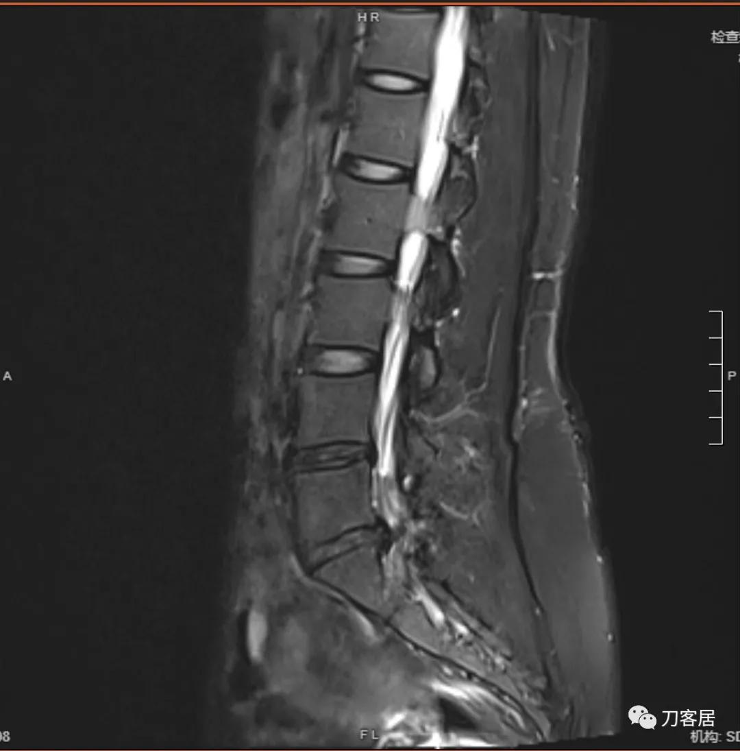 椎间孔镜微创手术13天,椎间孔镜微创手术患者