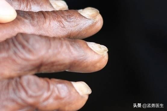 当你缺少蛋白质,身体缺乏的10种营养