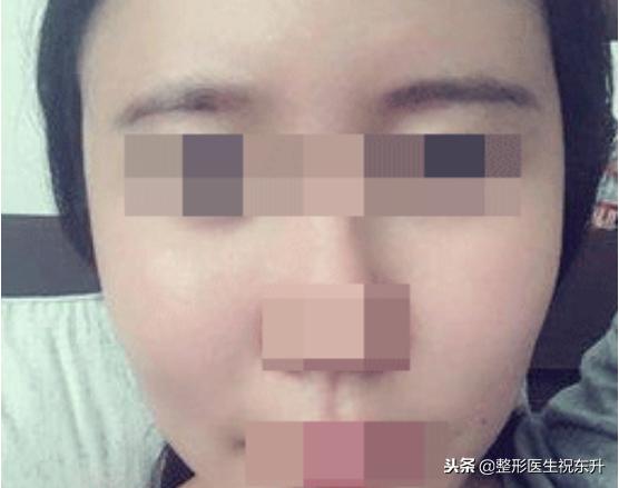 脂肪填充苹果肌多久消肿恢复自然,脂肪填充苹果肌一边多久吸收正常