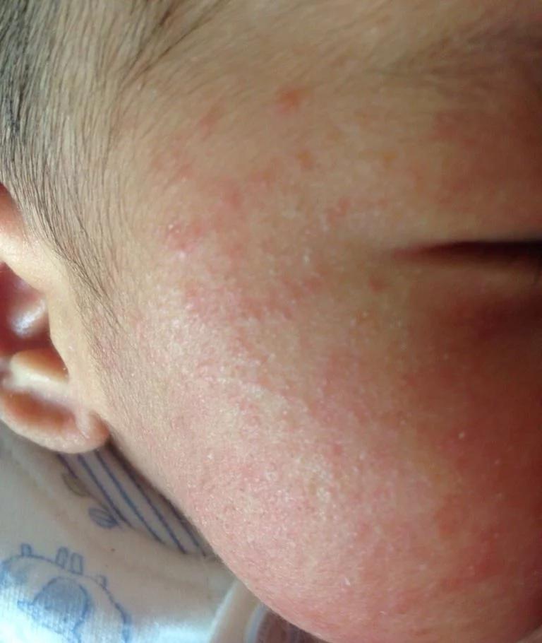 月嫂怎样解决宝宝湿疹问题,月子孩子起湿疹月嫂有责任吗