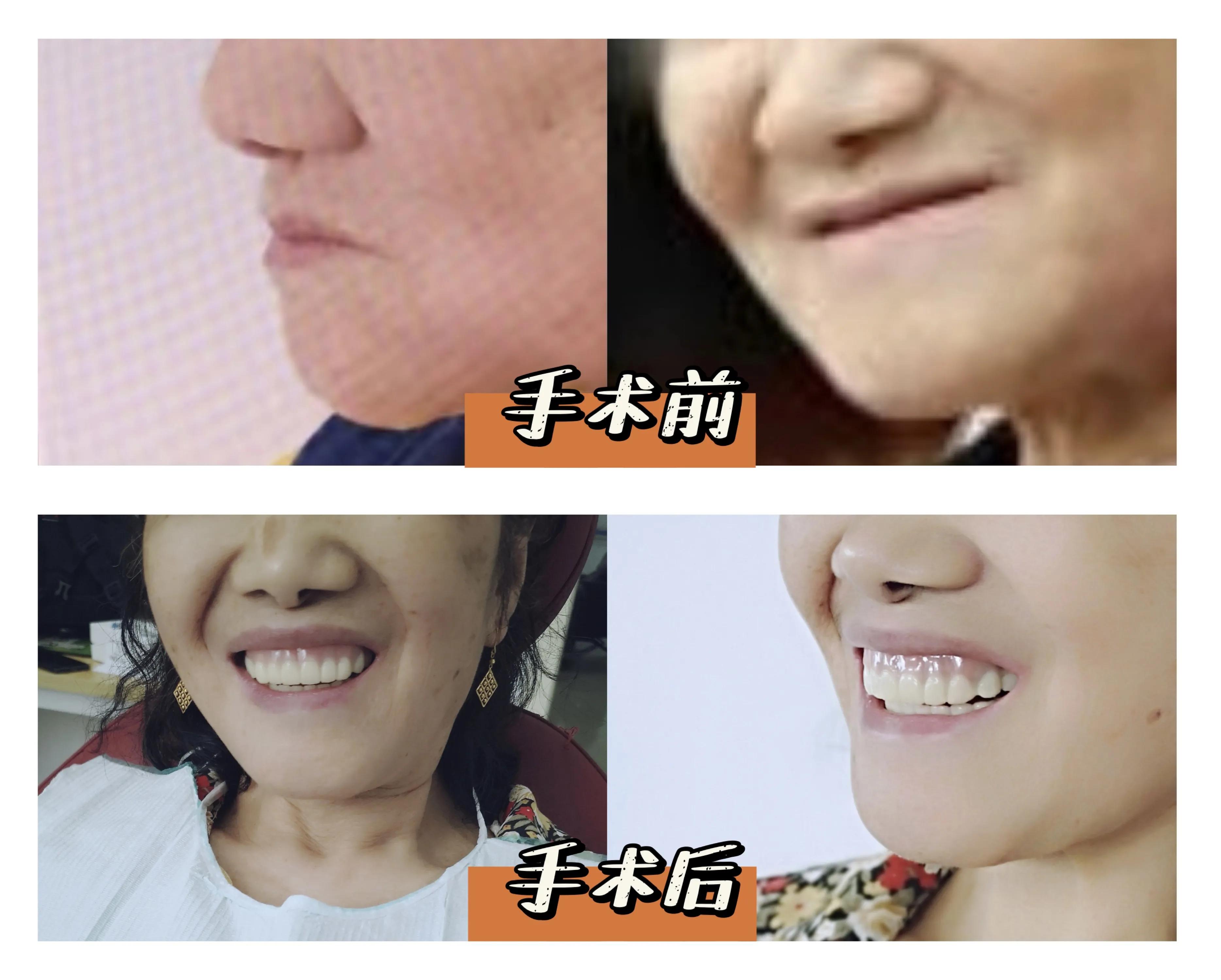 种植全口假牙价格多少,种植上下半口假牙得多少钱视频