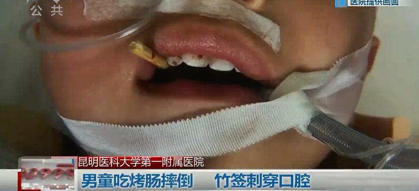 一根烤肠险些要了这个宝宝的命！8厘米竹签从口腔刺破咽喉，尖端险些刺入生命中枢