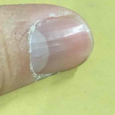 贫血怎么治也治不好,贫血怎么办快速解决