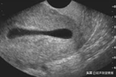3毫米卵黄囊未见胎芽正常么,40多天的卵黄囊
