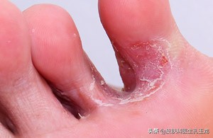 脚气皮肤科医生怎么说,皮肤科医生脚气小妙方