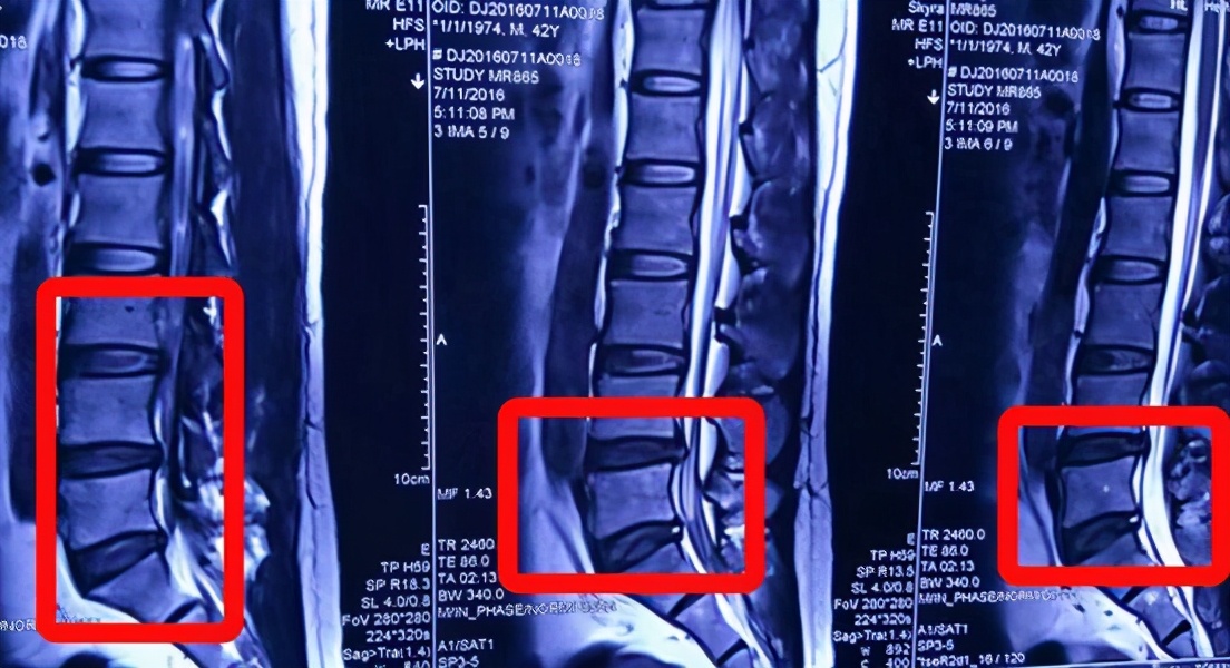 腰椎间盘突出不手术怎么治疗,腰椎间盘突出保守治疗是怎么治疗