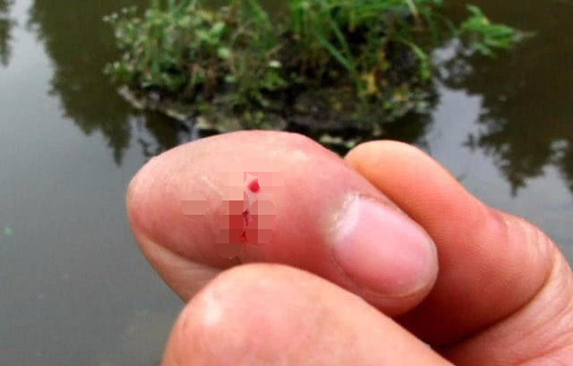 钓鱼鱼钩进喉咙里怎么办,野外钓鱼鱼钩刺入手指怎么办