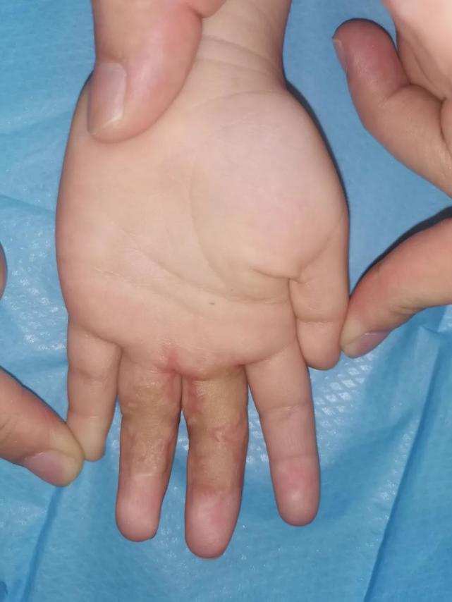 孩子被跑步机擦伤怎么处理,宝宝被跑步机磨掉了皮怎么护理