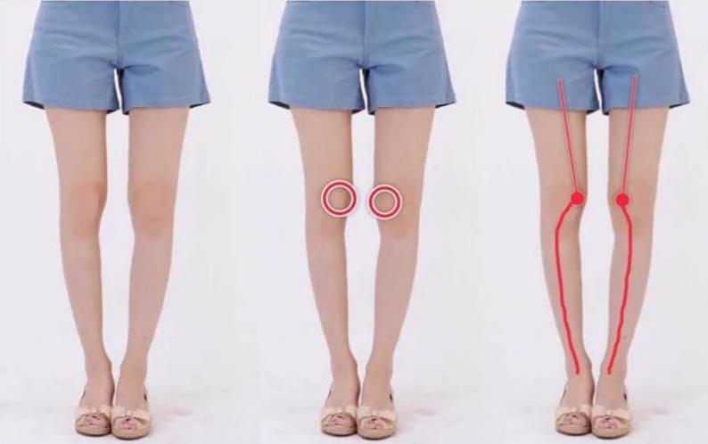 老年o型腿最快变直的方法,o型腿适合穿什么类型鞋