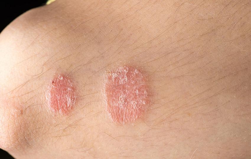 银屑疾病怎么控制好,银屑病为什么会大量掉屑