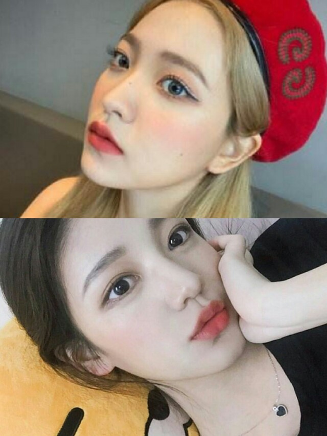 隆鼻好多年有鼻炎怎么办呢,有鼻炎的人做了隆鼻会怎样