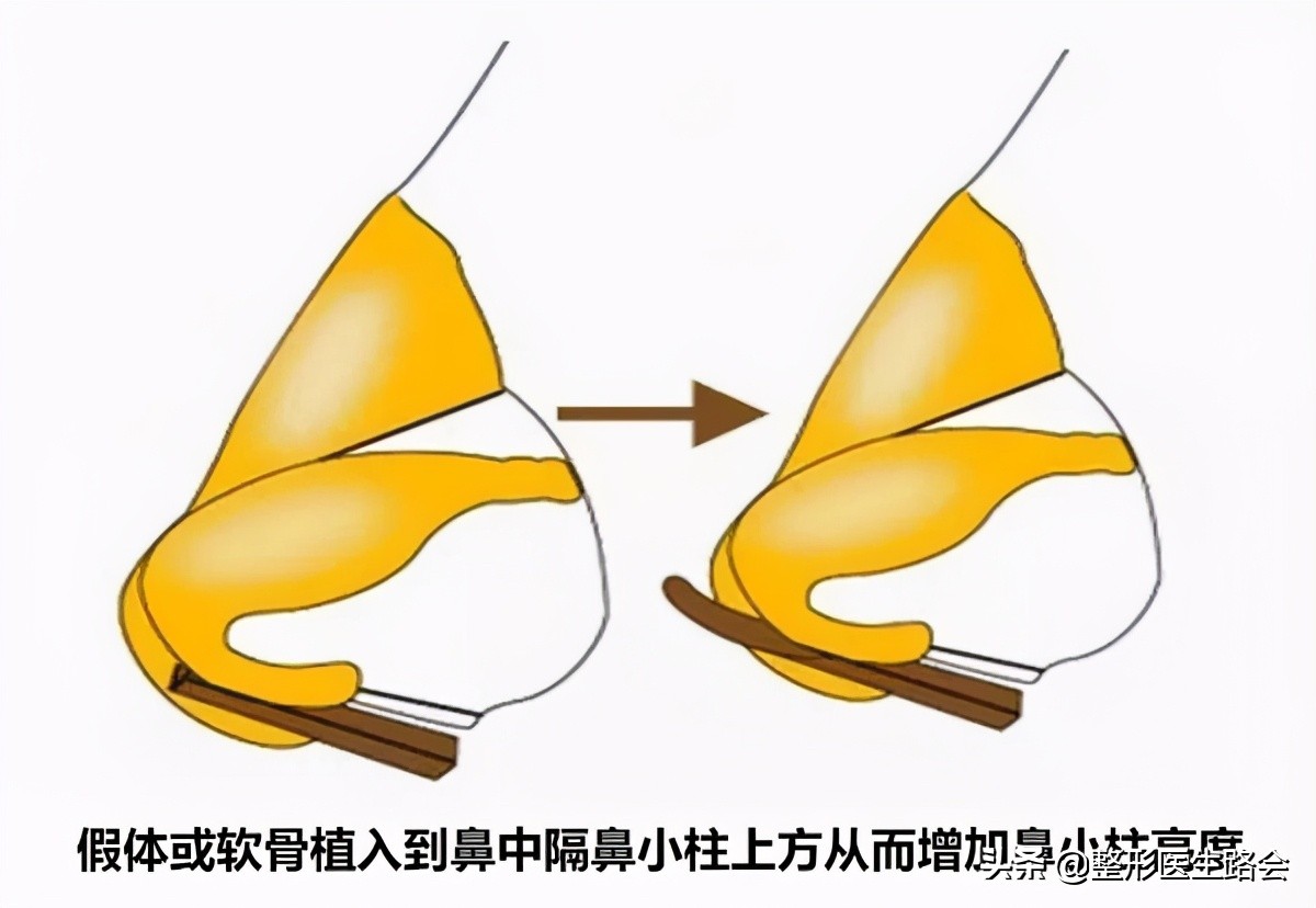 挤黑头鼻头大会变小,挤黑头鼻头会越来越大吗