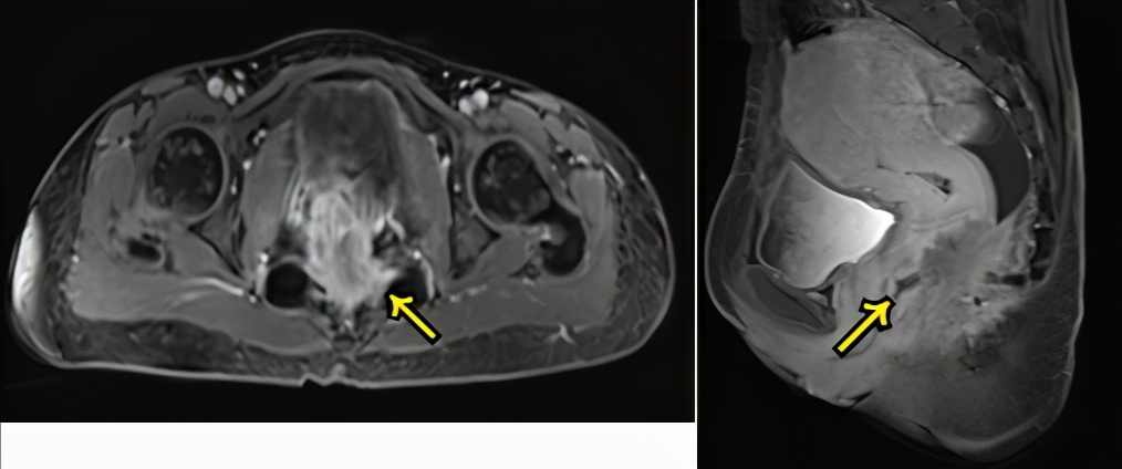 直肠癌放化疗后两年未复发,直肠癌术后放化疗有复发的吗