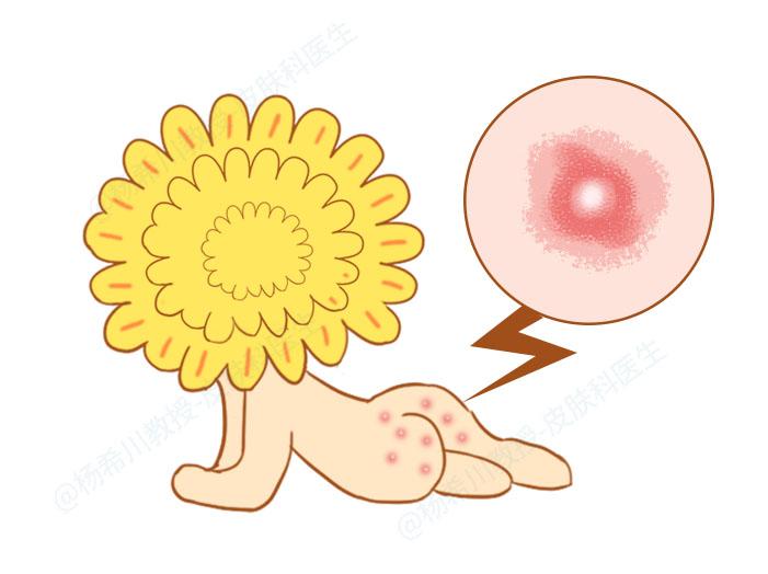 肛门瘙痒总想抠，怎么办？当心是这3类疾病