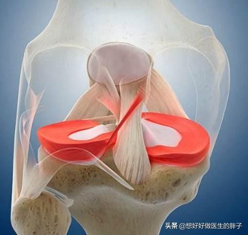 膝盖半月板撕裂还可以跑步吗,半月板撕裂未触及关节面能自愈吗