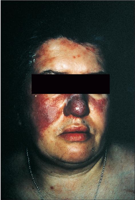 结节病关节痛眼睛模糊,结节病引起的关节炎