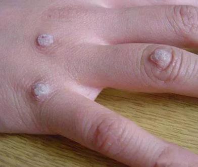 瘊子会自己消失不用治？NO！你的瘊子会传染全家人！