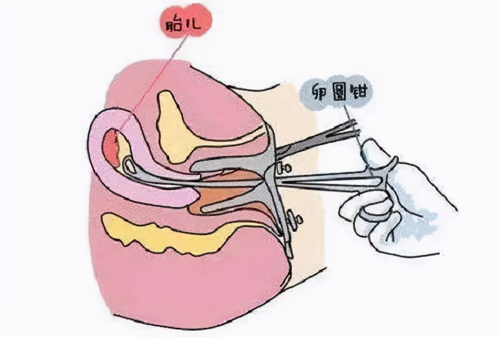 子宫后位怀孕了需要注意什么吗,子宫后位怀孕后需要注意什么