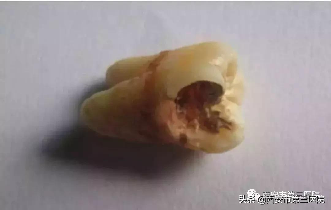 拔智齿不拔牙根会怎么样,拔下面智齿上面不拔可以吗