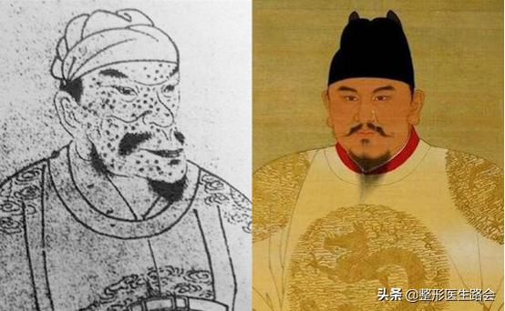 面中部凹陷下巴微翘,朱元璋式下巴怎么矫正