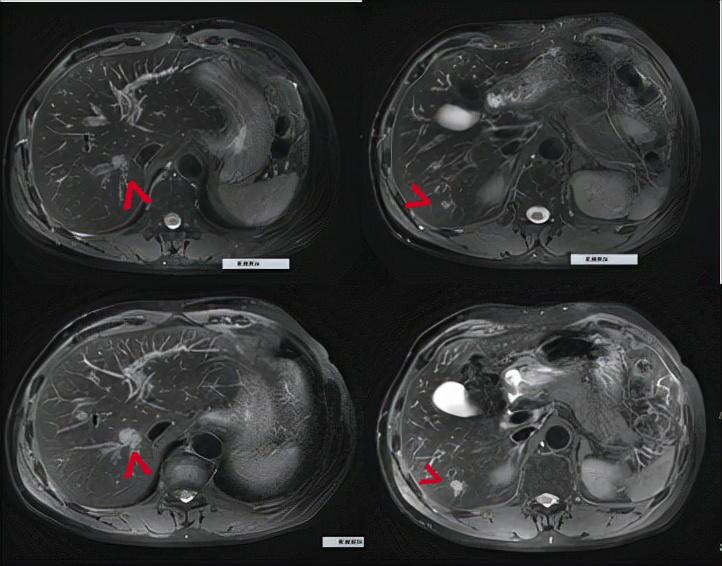 精准放疗高效解决鼻咽癌免疫治疗后寡进展病例分享