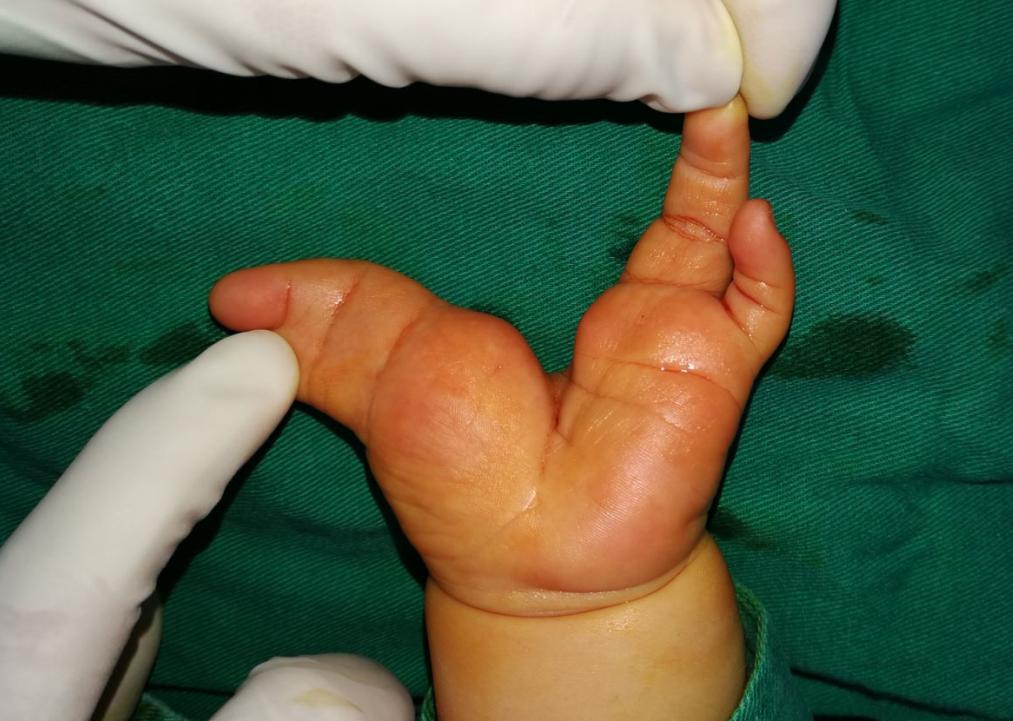 并指畸形免植皮案例,并指畸形