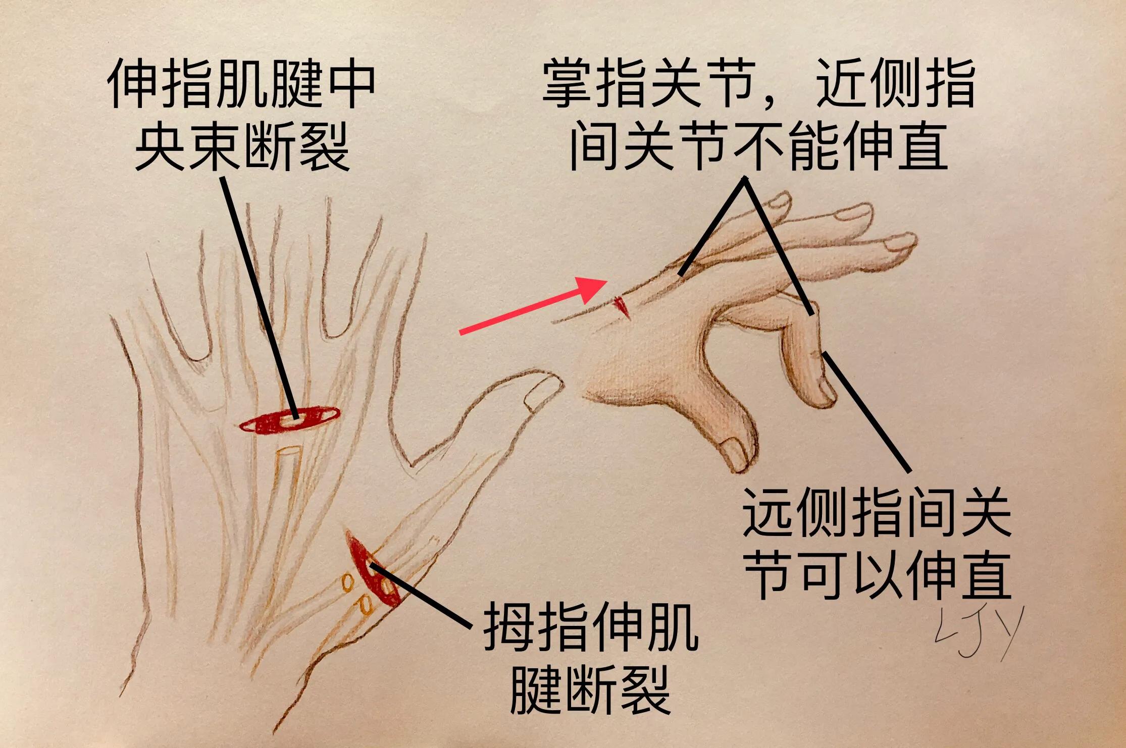 手被割伤如何处理,手被割伤了较深要如何处理