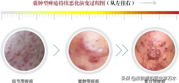 痘痘十大真相,痘痘大全图解