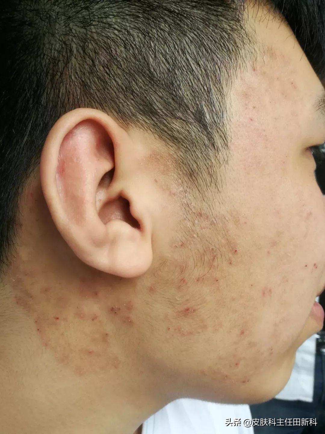 脸上痘印变成癣了怎么回事,痘印长癣