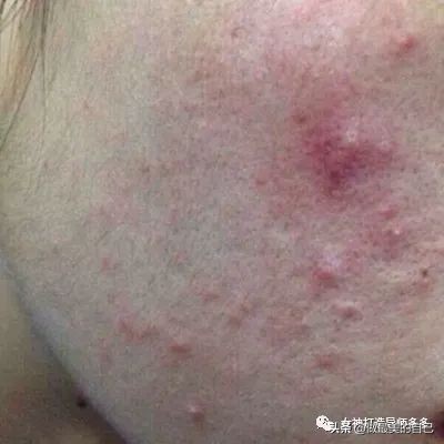 痘印长期不消怎么办,痘印反复消不下去怎么办