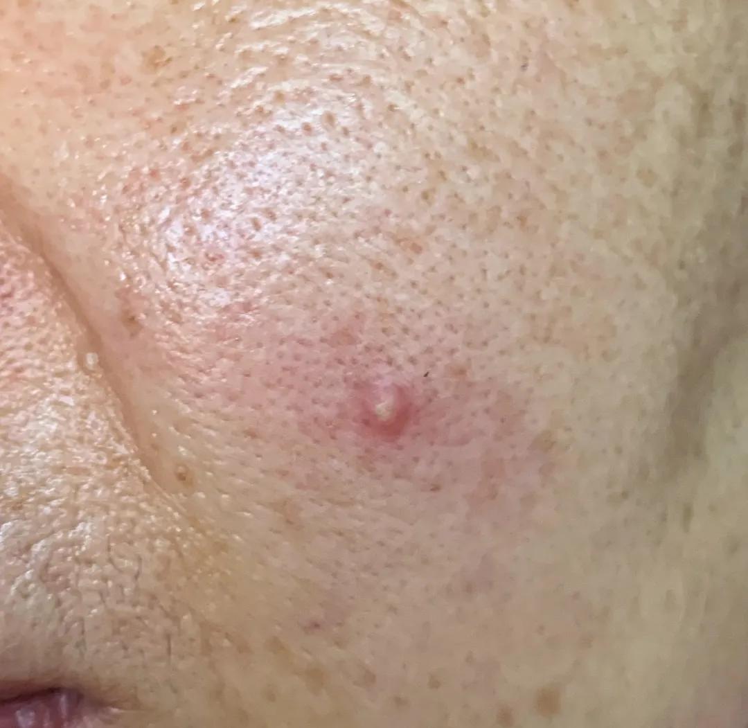 每到换季就会爆痘,换季时爆痘