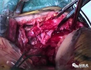 肩锁关节脱位手术后多久可以喝酒,肩锁关节脱位钢板内固定步骤记录