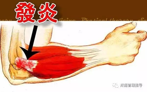 网球肘能自我恢复吗,网球肘病因的解剖学研究