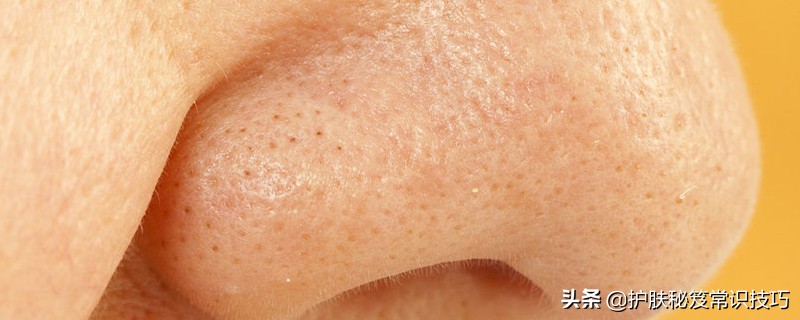 挤出大黑头的洞怎么处理,黑头后的洞怎么处理