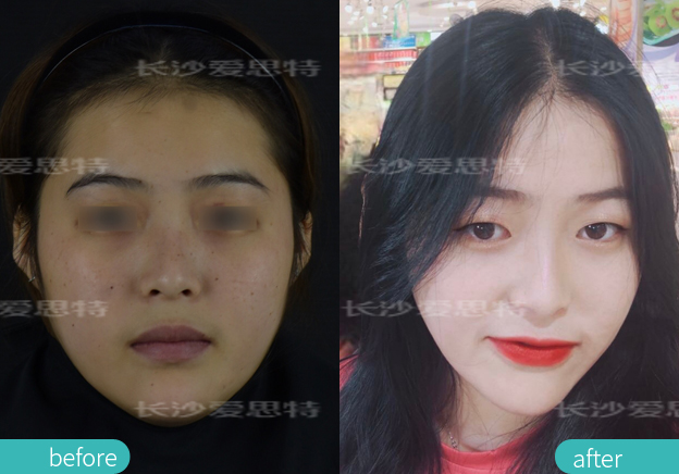 雀斑适合光子嫩肤还是皮秒,祛雀斑用超皮秒好还是光子嫩肤好