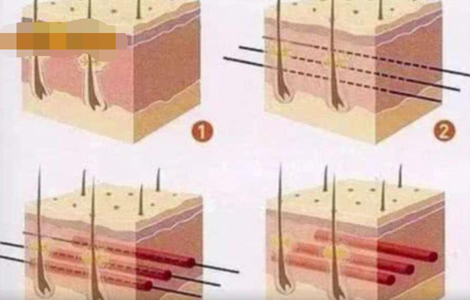 女子为变美花掉300余万后续,女子为变美脸塌陷