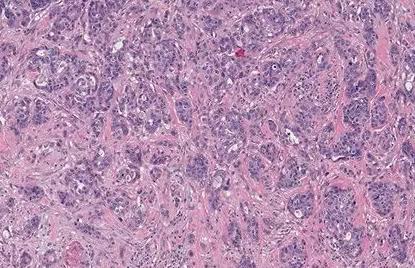 肠息肉切除后3年得肠癌,女性肠息肉切除多久可以恢复