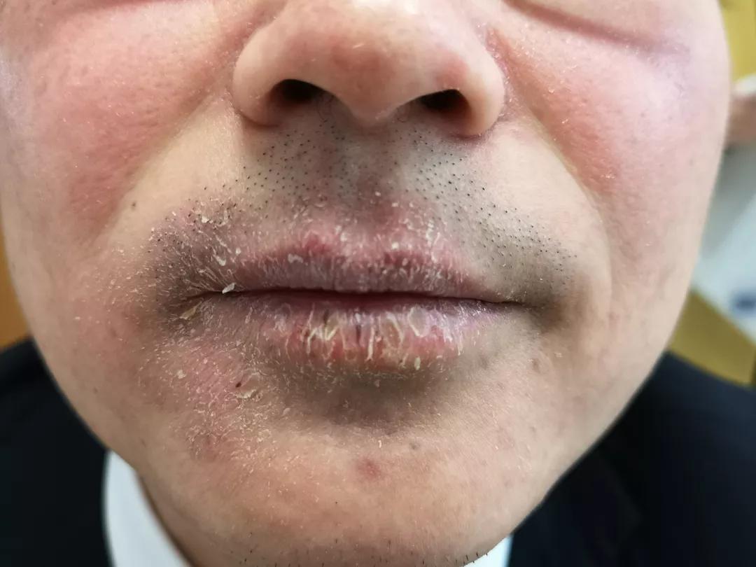 口周皮炎会留印吗,口周皮炎留下色素能好吗