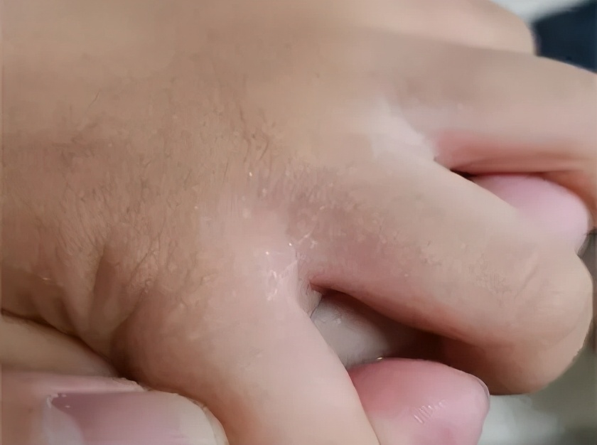 天一热手上就起一层小疙瘩还很痒,两只手上长密集的小疙瘩很痒很红