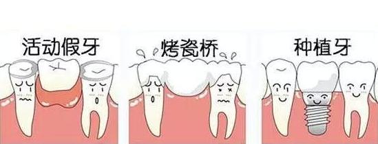 掉了三颗牙能做烤瓷牙吗,被牙医坑做烤瓷牙